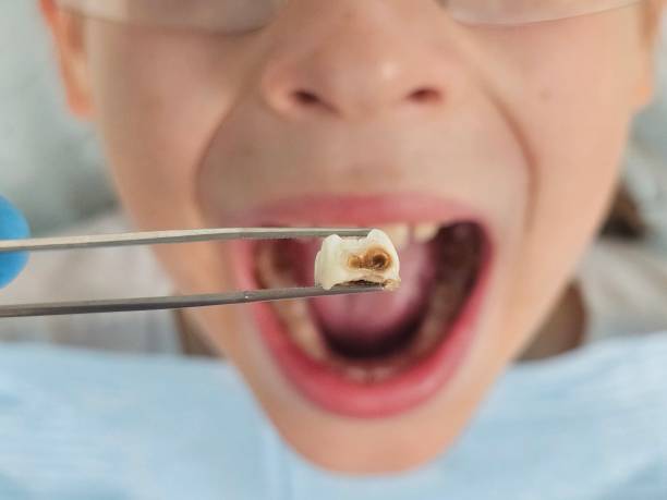 Best Emergency Wisdom Tooth Extraction in Luray, VA